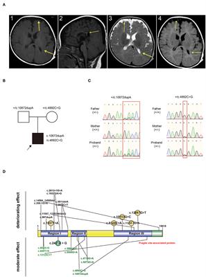 Compound Heterozygous Variants in a Surviving Patient With Alkuraya-Kučinskas Syndrome: A New Case Report and a Review of the Literature